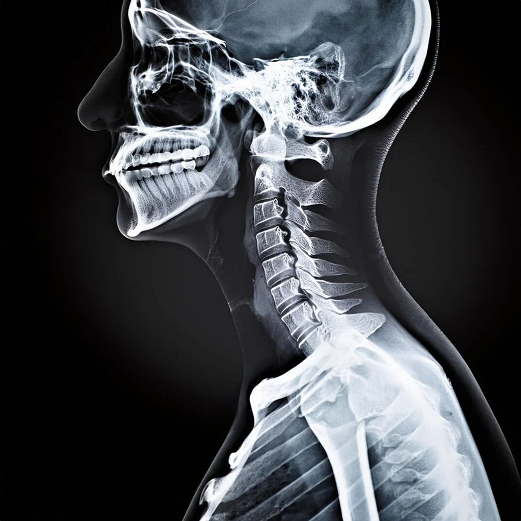 Spinal alignment